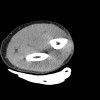 SPORK, NICO - 22.03.1976 - 02.08.2022 - CT obere Extremität - 17:56:57